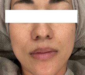 リジュラン施術前